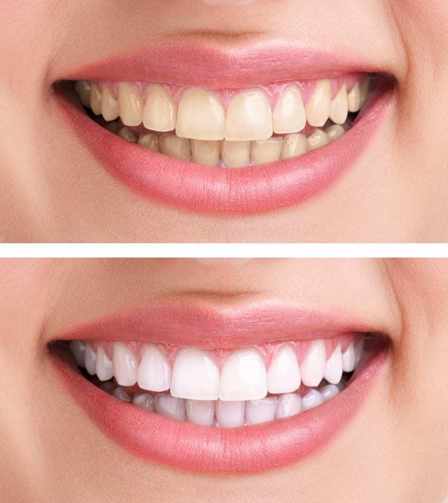 Blanc Smiles Starter Whitening Bundle
